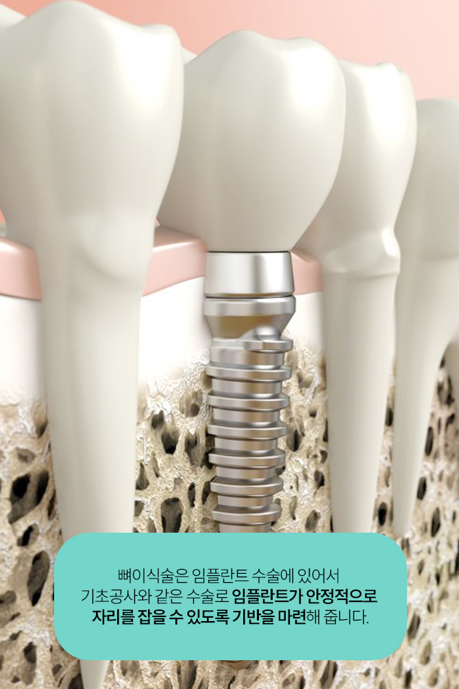 강남역 임플란트 뼈이식 잘하는 곳 뉴엔치과 관련 이미지 3