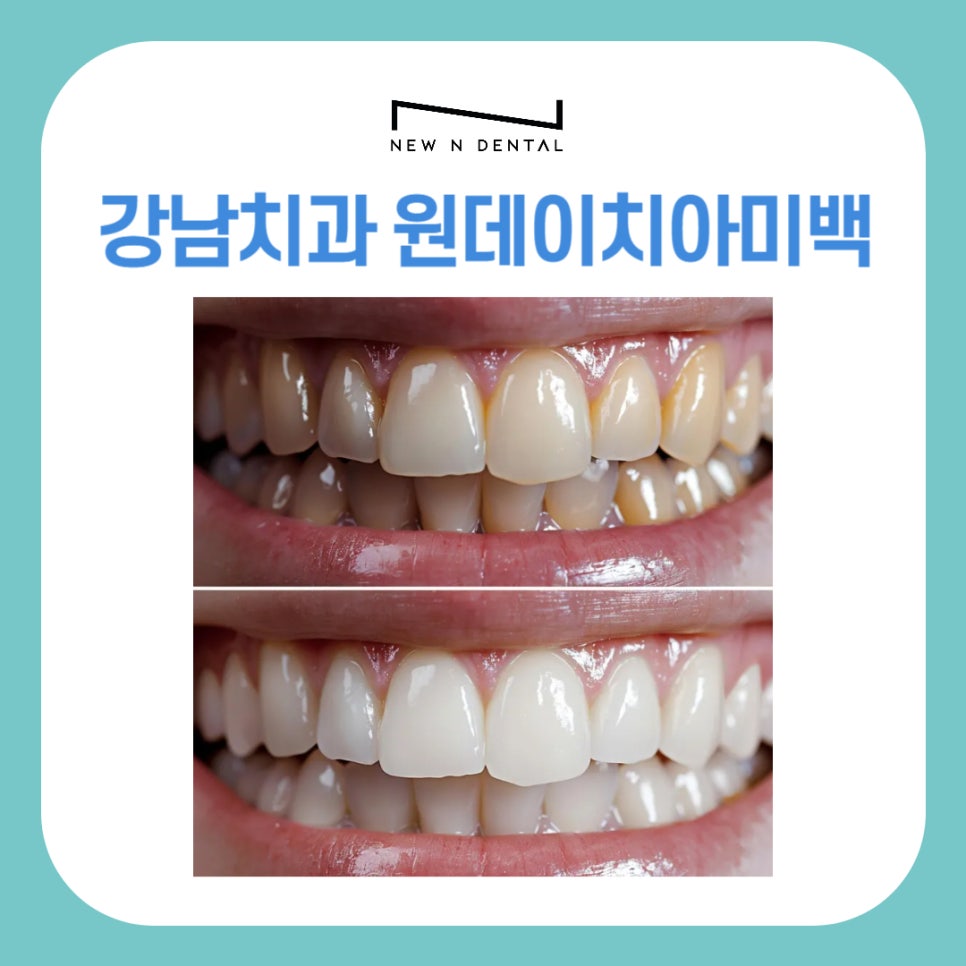 강남치과 원데이치아미백 누런치아 탈출 관련 이미지 1