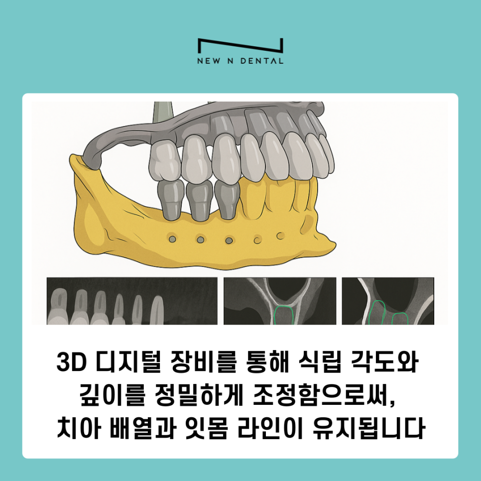 앞니 임플란트 식립 주의해야 할 사항은? 관련 이미지 8