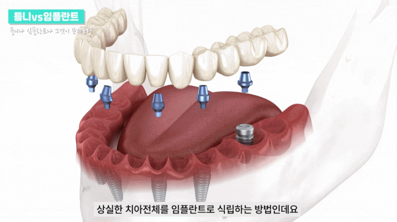 강남 전체임플란트 틀니 생각하고 있다면 관련 이미지 4