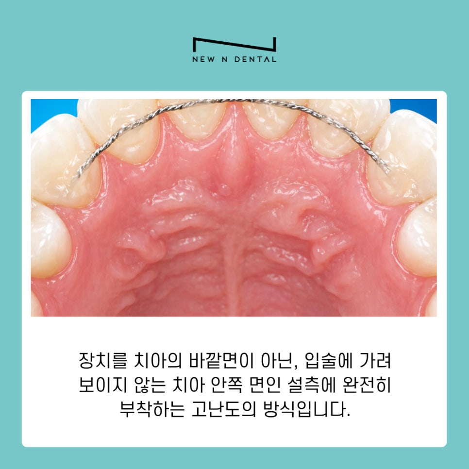 A Guide to Choosing the Right Orthodontic Appliance for You from a Yeoksam-dong Orthodontic Clinic image 8