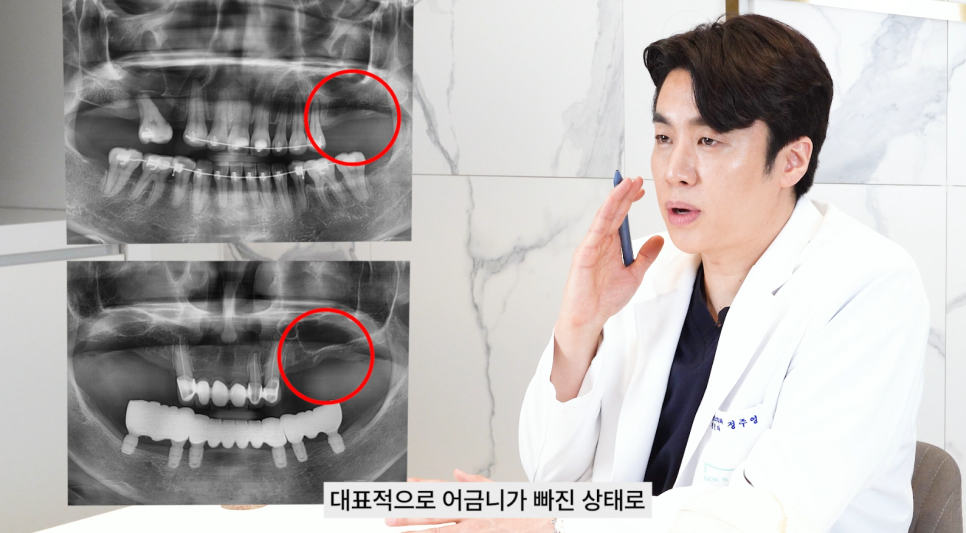 상악동거상술 임플란트 성공률 높이기 관련 이미지 4