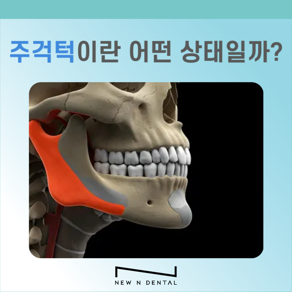 비수술 주걱턱 치아교정 이런 분들께 추천해요 관련 이미지 4