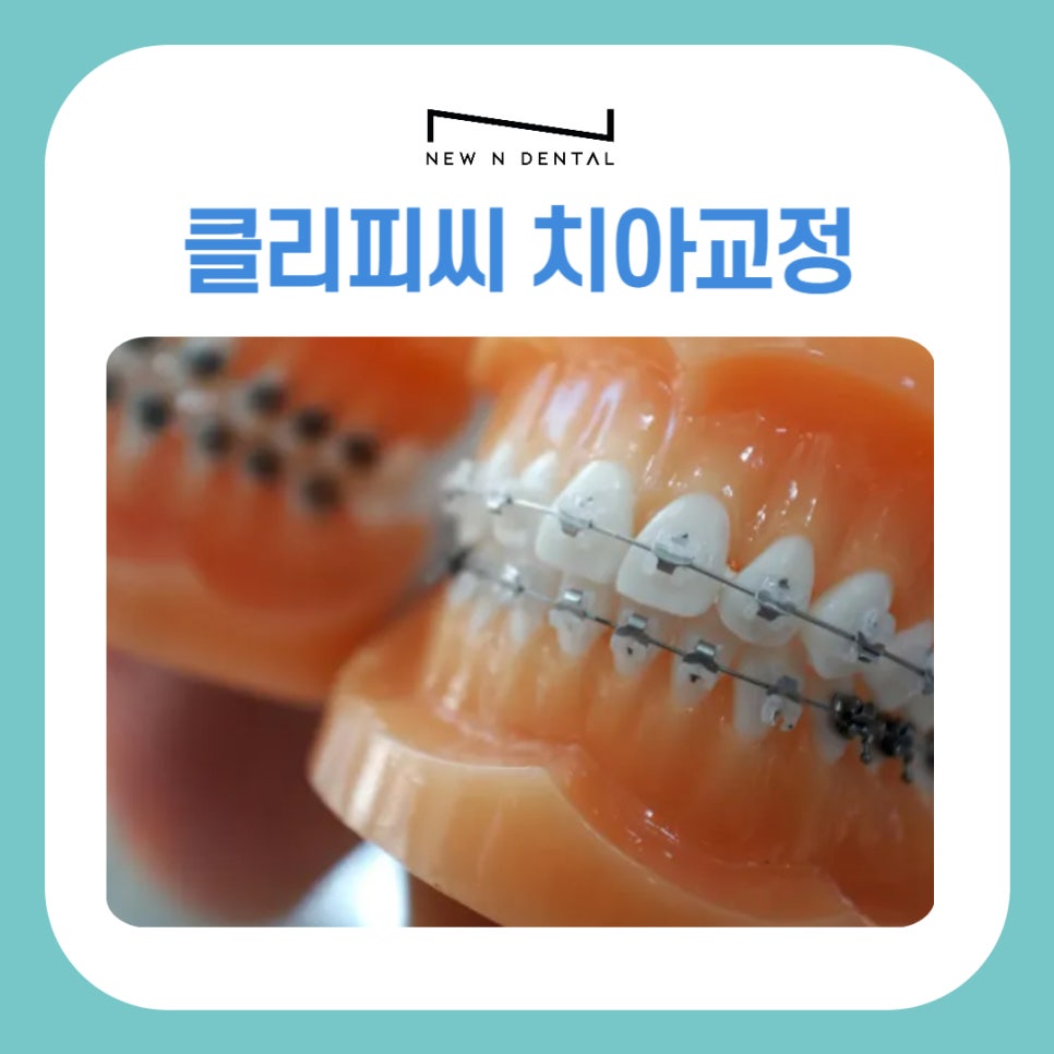 강남 클리피씨 교정기간 짧은 찐후기 관련 이미지 2