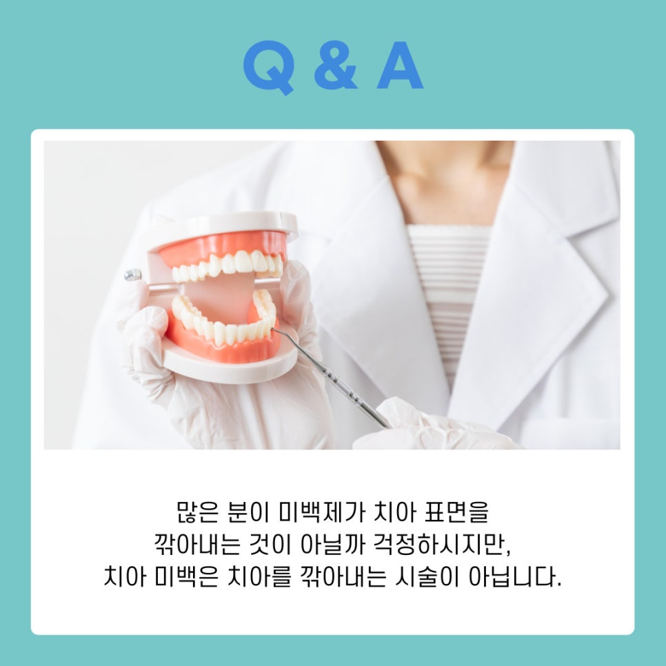 치과 치아미백의 원리부터 종류별 특징까지 완벽 가이드 관련 이미지 8