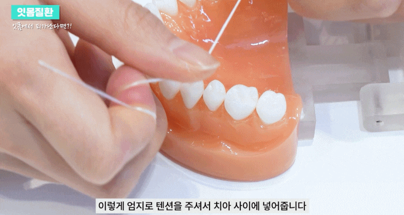 잇몸질환의 종류 출혈이 있을 때 예방방법 관련 이미지 14