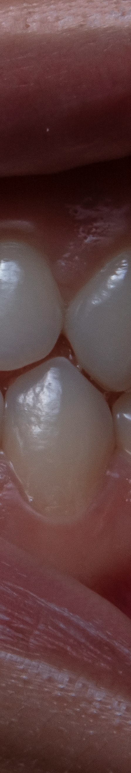 치아 미백 효과와 부작용 체크해야 할 사항 관련 이미지 24