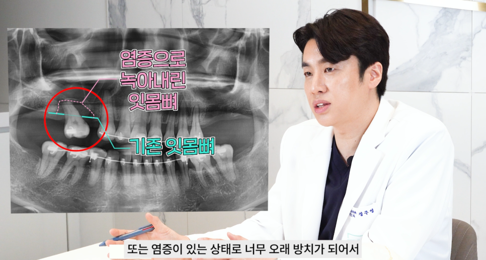 논현역치과 상악동거상술 어떤 치료일까 관련 이미지 5
