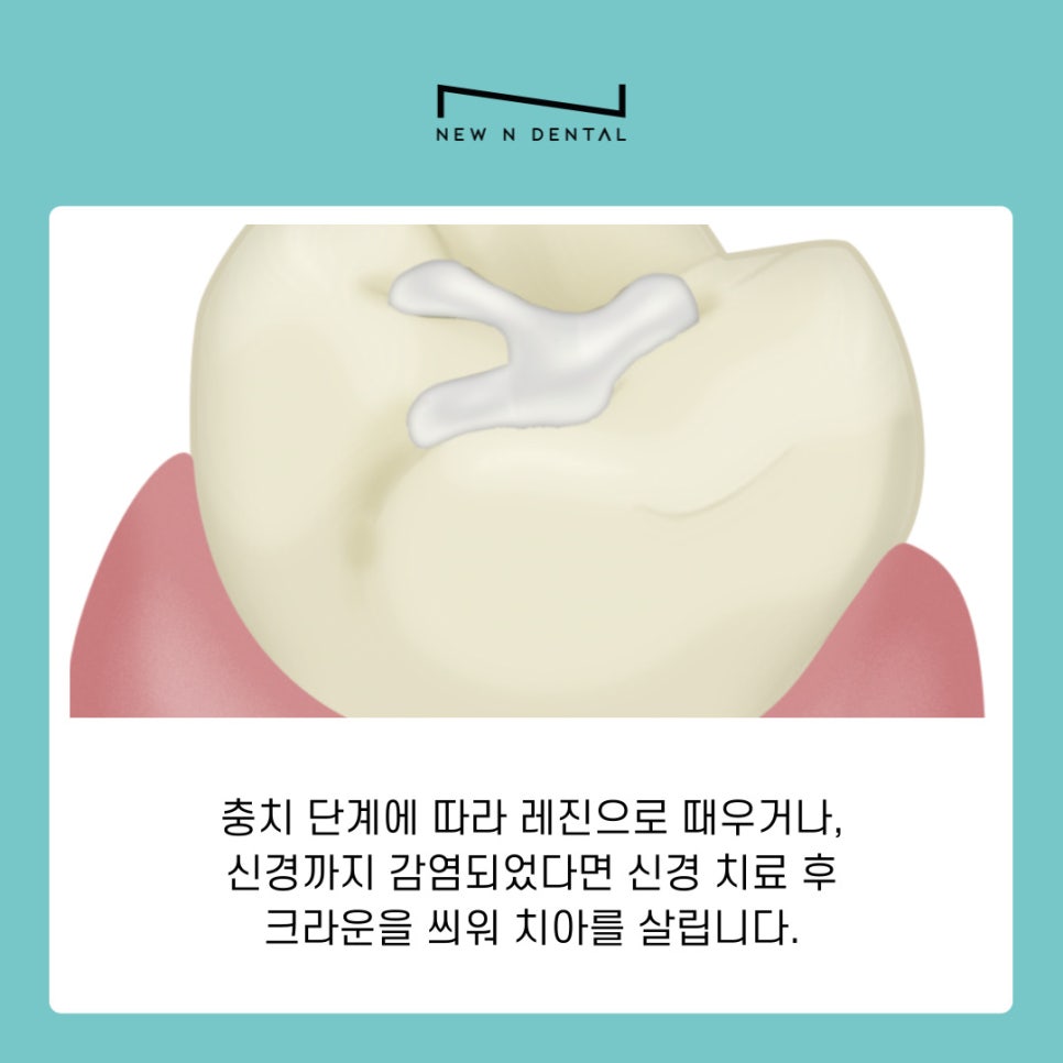 치통 원인부터 예방법까지 욱신거리는 고통 참지 말고 대처하세요 관련 이미지 5