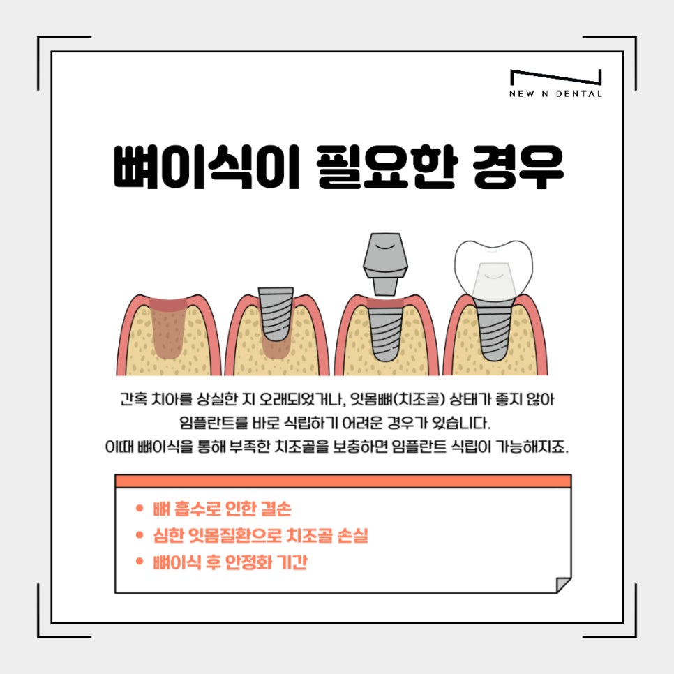 강남임플란트치과 치료부터 뼈이식까지 관련 이미지 3