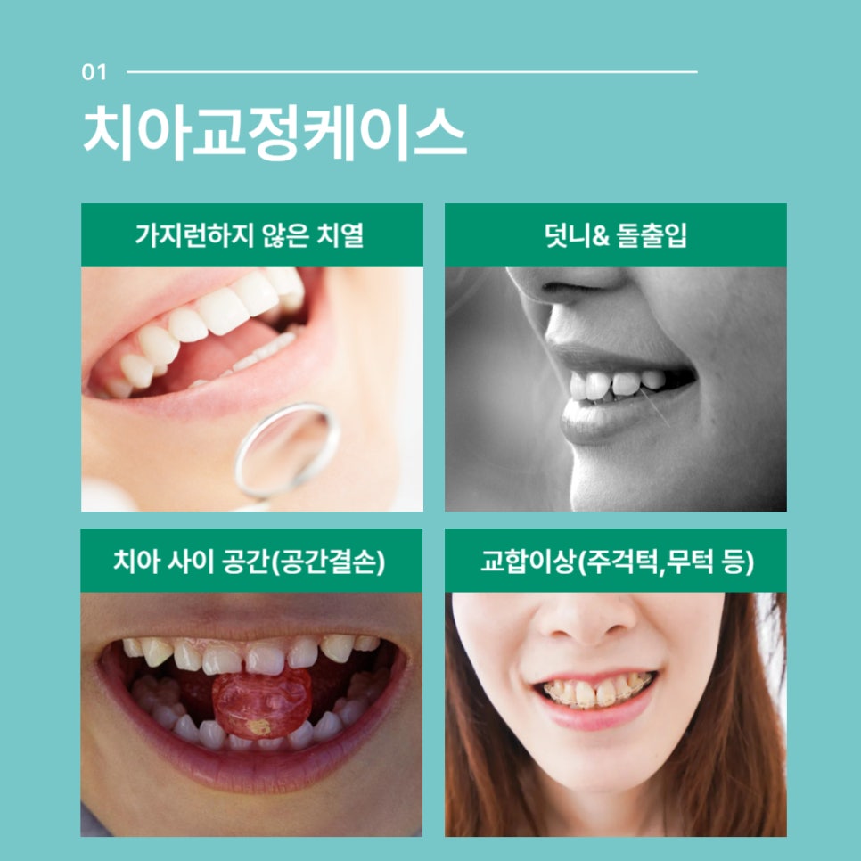 Adult Orthodontic Treatment Costs and Cases image 2