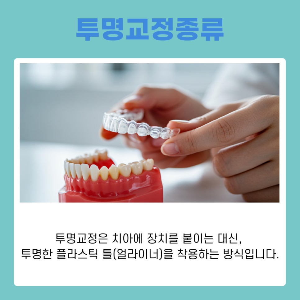 Orthodontics Near Gangnam Station: Differences Between Anterior Lingual Braces and Clear Aligners by Type image 6