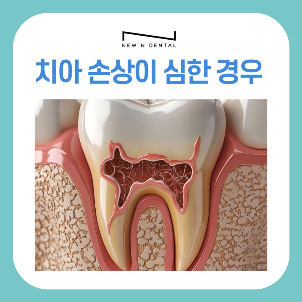 강남역 치과 전체임플란트 추천 어떤 분들이 대상일까? 관련 이미지 6