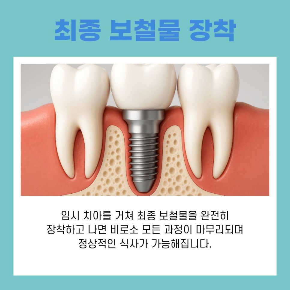 Dental Implant Surgery Process and Care Methods at Gangnam Station image 8