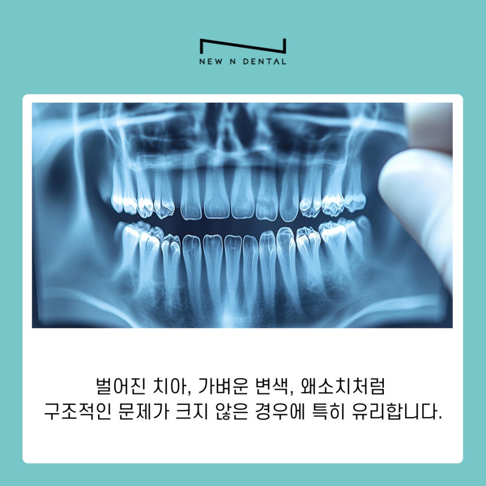 라미네이트 치아삭제 없이도 가능한 치아성형 알아보기 관련 이미지 8