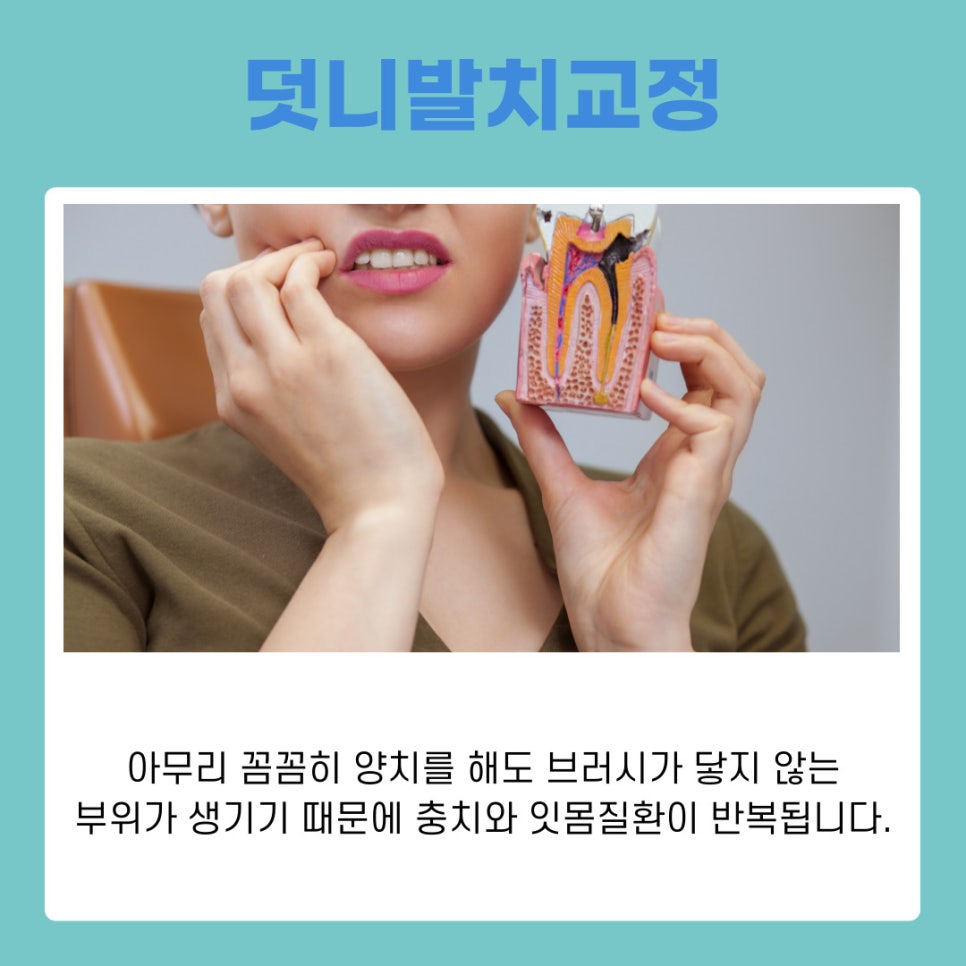 강남역교정치과 덧니발치교정 치아 건강과 심미성 모두 잡는 방법 관련 이미지 4