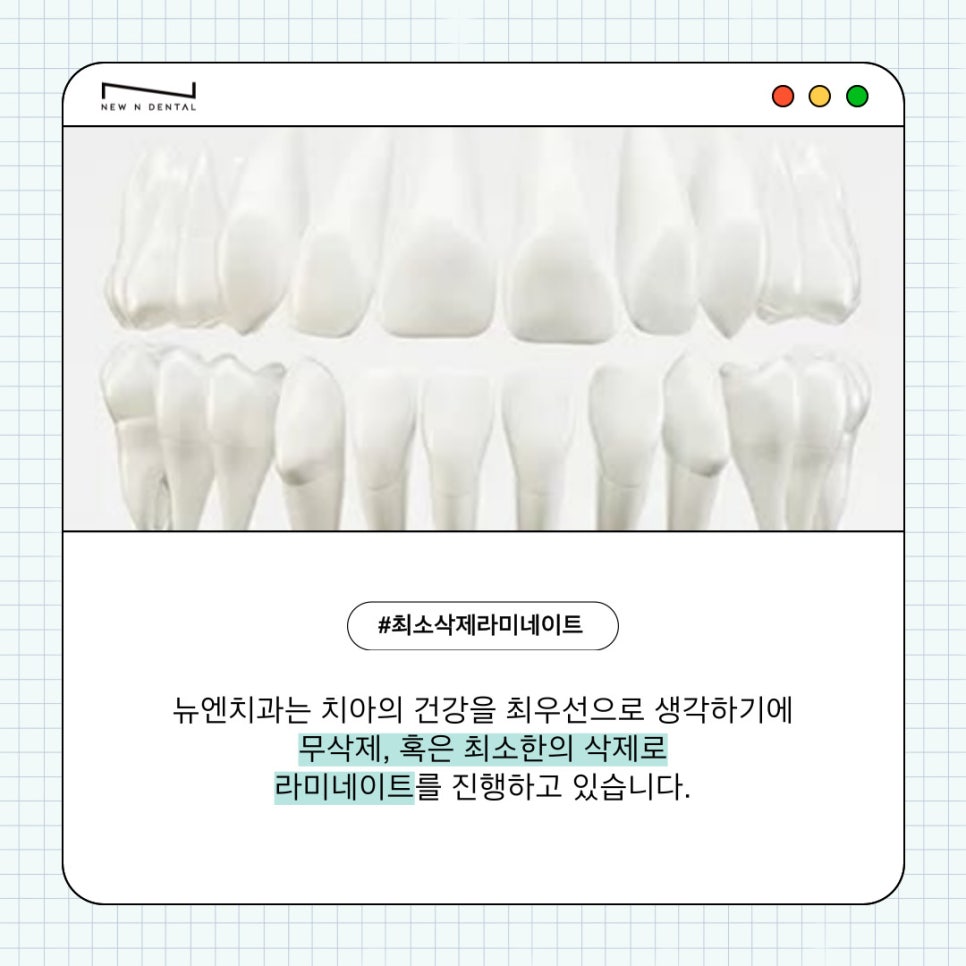 자연치아를 최대한 보호하는 최소삭제라미네이트 관련 이미지 10