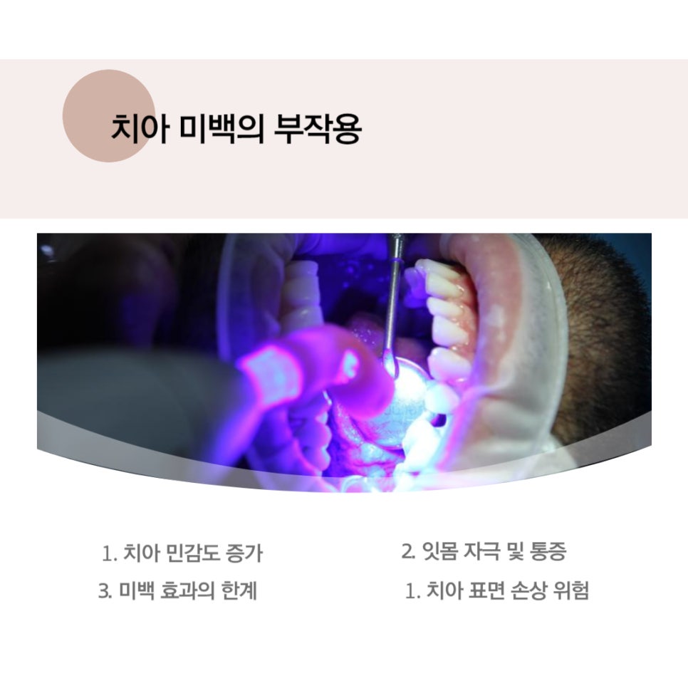 치아 미백 효과와 부작용 체크해야 할 사항 관련 이미지 4
