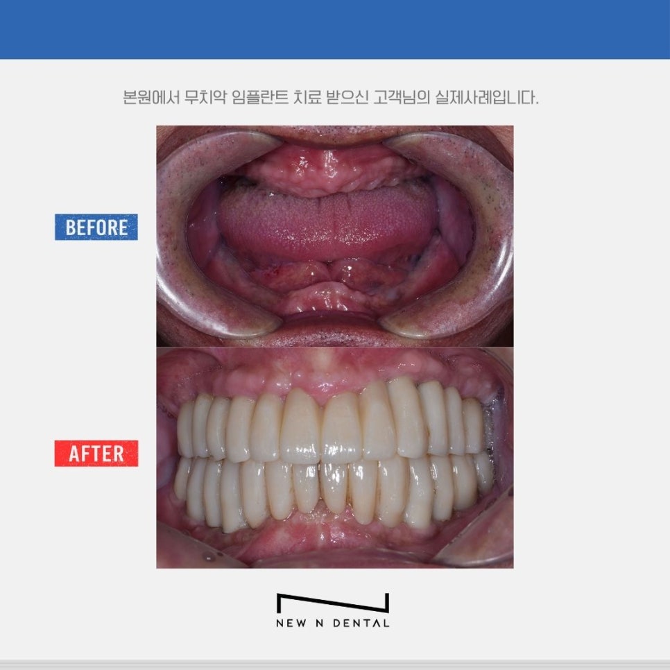신논현치과 무치아 임플란트, 틀니보다 확실한 선택 관련 이미지 8