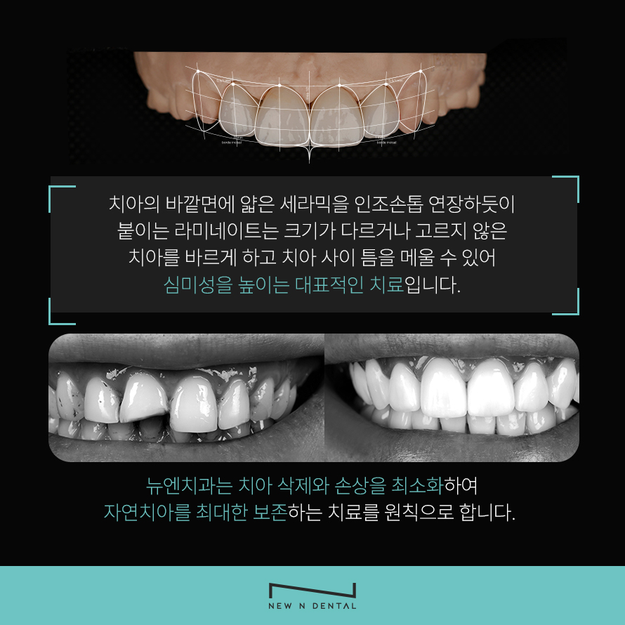 논현동라미네이트 인상이 좋아 보이도록 관련 이미지 4