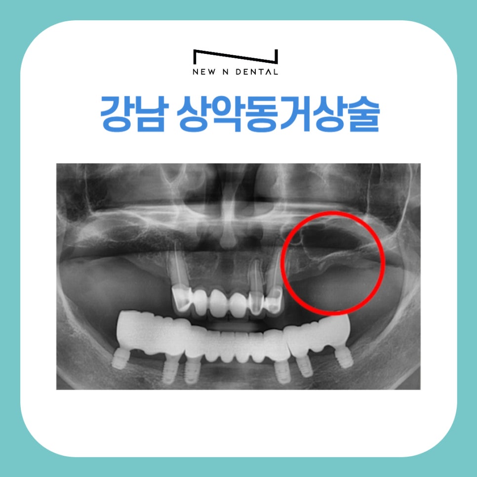 상악동거상술 임플란트 성공률 높이기 관련 이미지 1