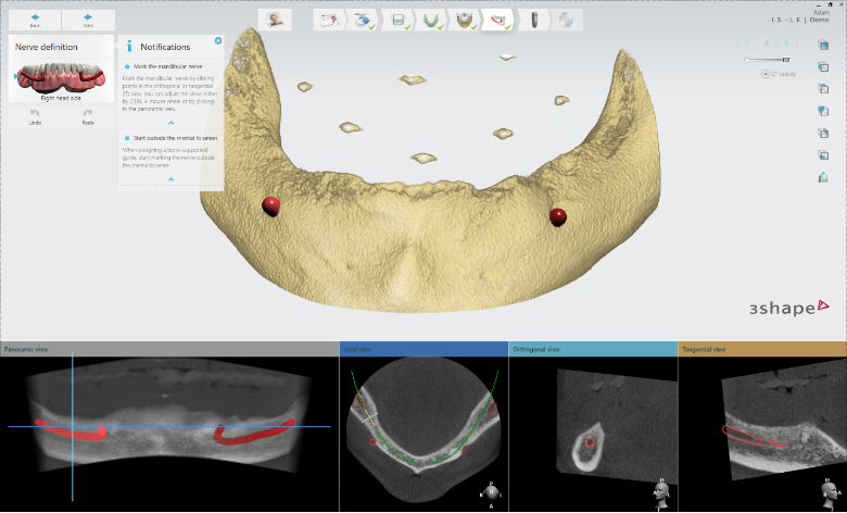 역삼동임플란트 컴퓨터로 상세하게 치료 관련 이미지 6
