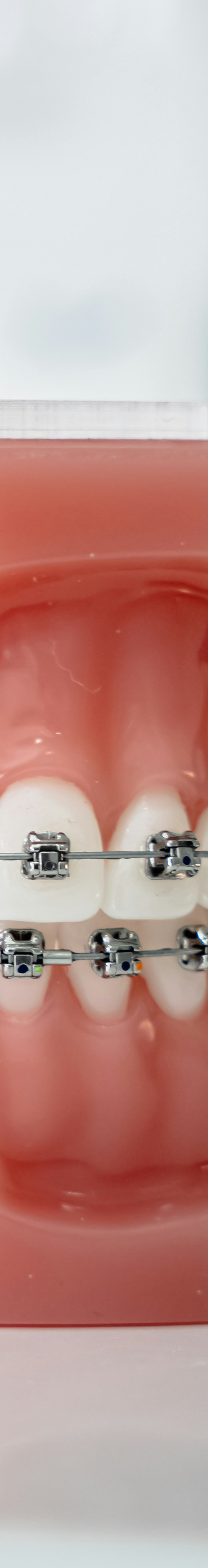 치아교정 종류 장단점 알아보기 관련 이미지 16