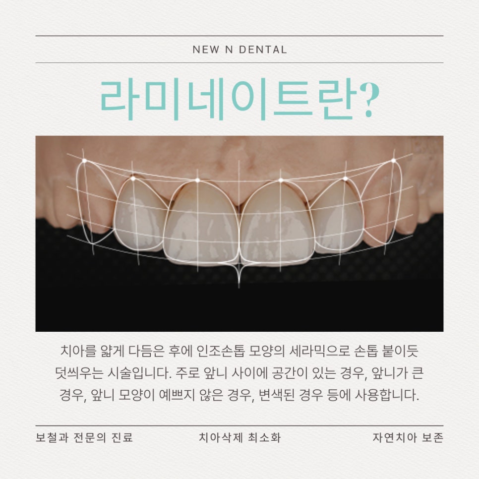 앞니심미치료로 되찾는 자연스러운 스마일 라인 관련 이미지 2