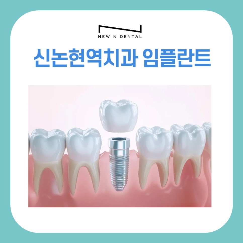 신논현역치과 임플란트 비용&middot;시술&middot;주의사항 총정리 관련 이미지 1
