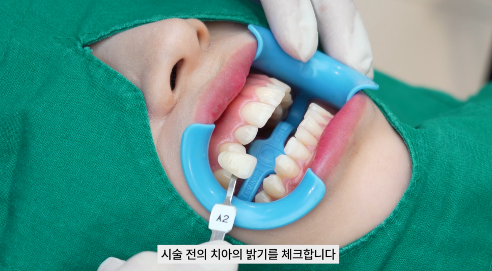 강남치과 원데이치아미백 누런치아 탈출 관련 이미지 4