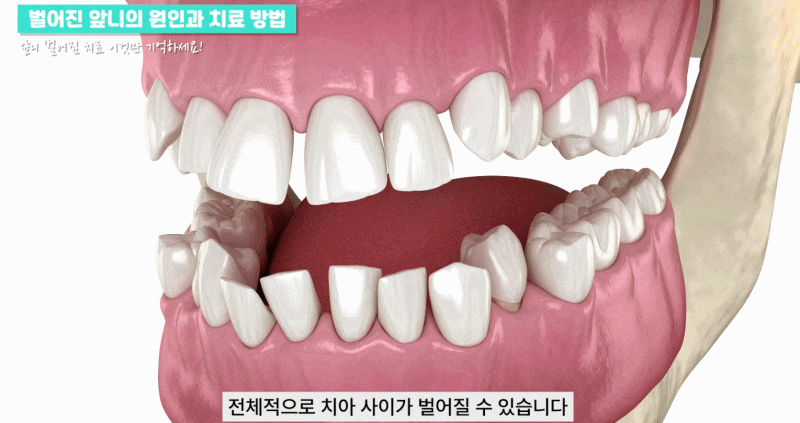 강남역치과 앞니 벌어짐 원인, 치료와 방법 관련 이미지 10