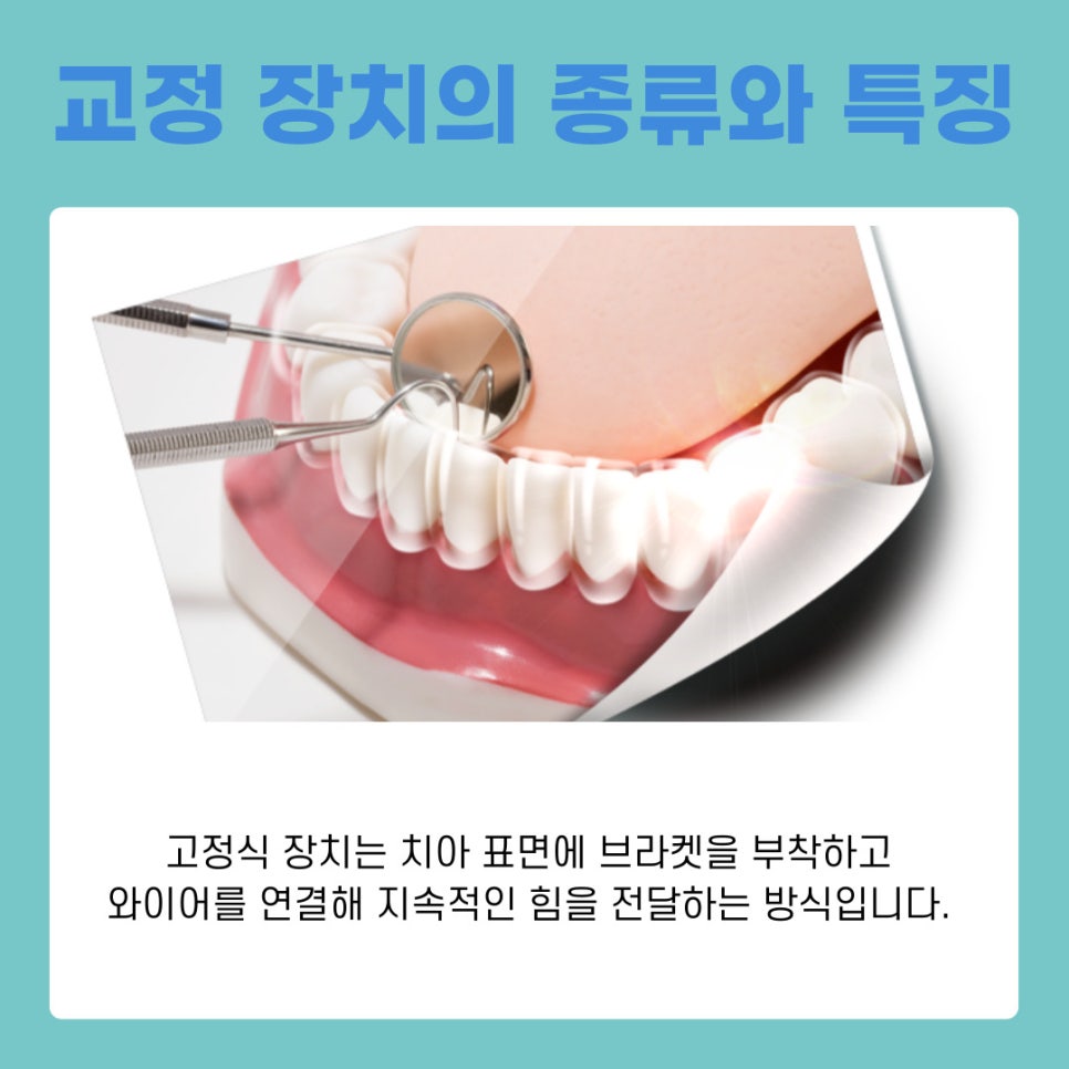 서초구교정치과 치료 전 반드시 알아야 할 기본 정보 정리 관련 이미지 4