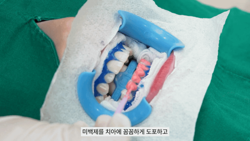 강남역미백치과가 전하는 치아미백의 모든 것 관련 이미지 5