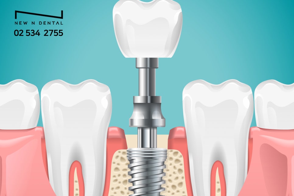 임플란트치과병원 현명하게 고르는 방법 관련 이미지 6