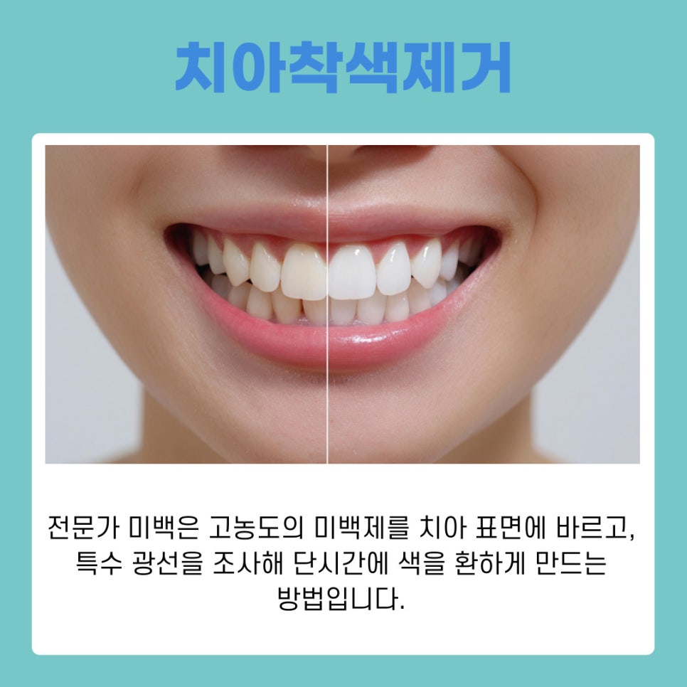 강남역 치아미백 누런니 고민해결 밝은 미소 되찾는 법 관련 이미지 5