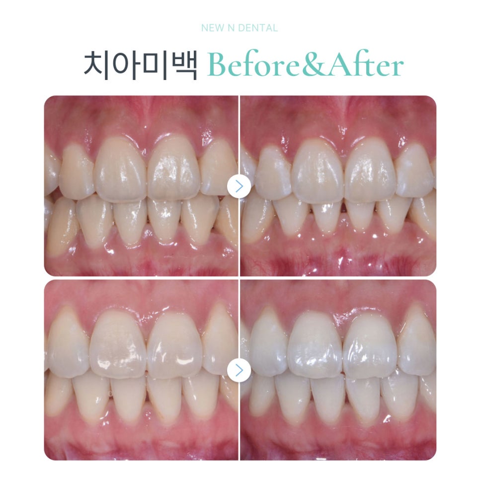강남역미백치과가 전하는 치아미백의 모든 것 관련 이미지 6