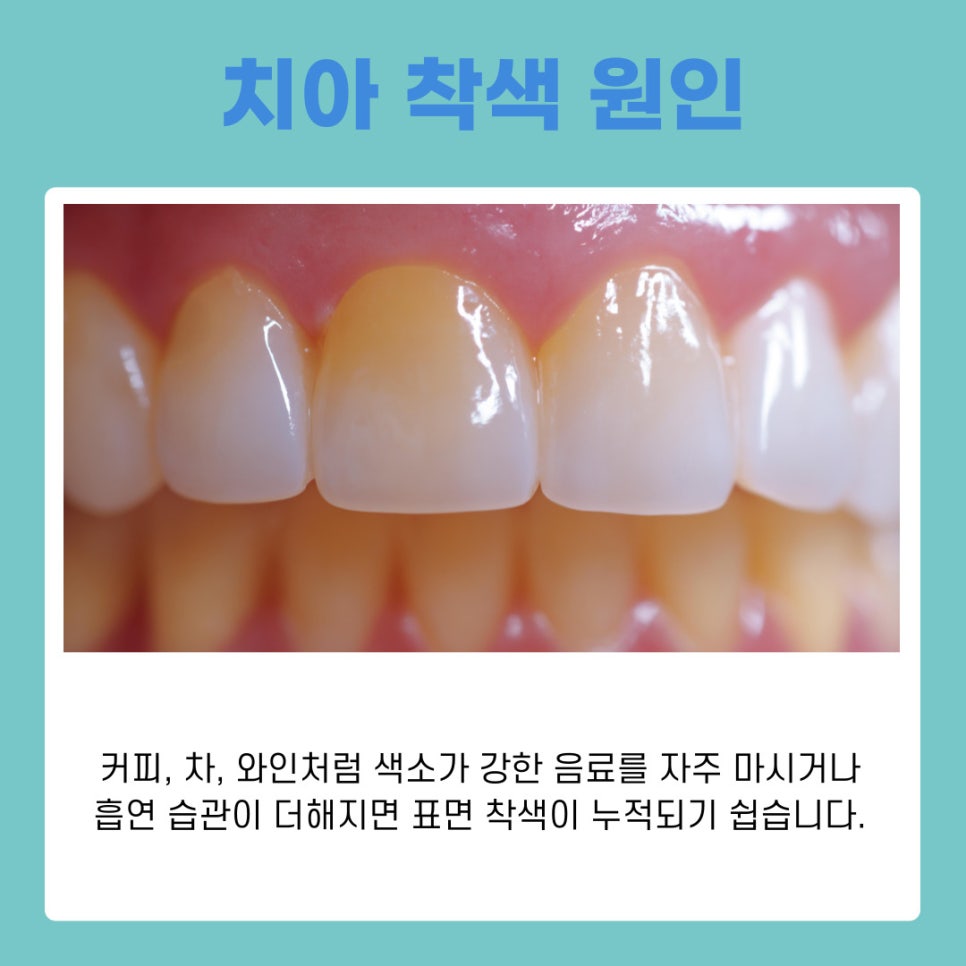 강남 논현동치과 치아미백 작용 원리와 유지 관리 방법 정리 관련 이미지 3