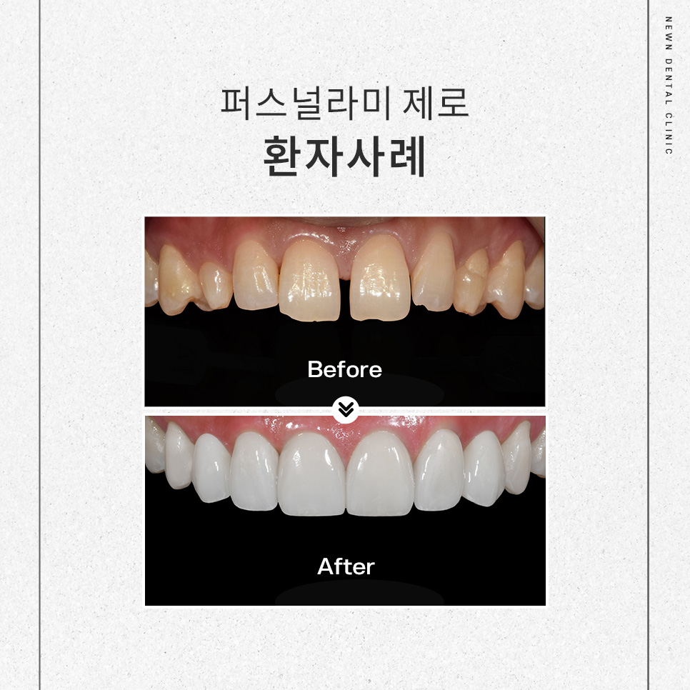 [뉴엔치과] 강남 무삭제 라미네이트, 퍼스널라미 제로 관련 이미지 6