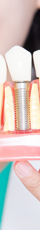 강남 임플란트 재수술, 어떤 경우에 필요할까 관련 이미지 13