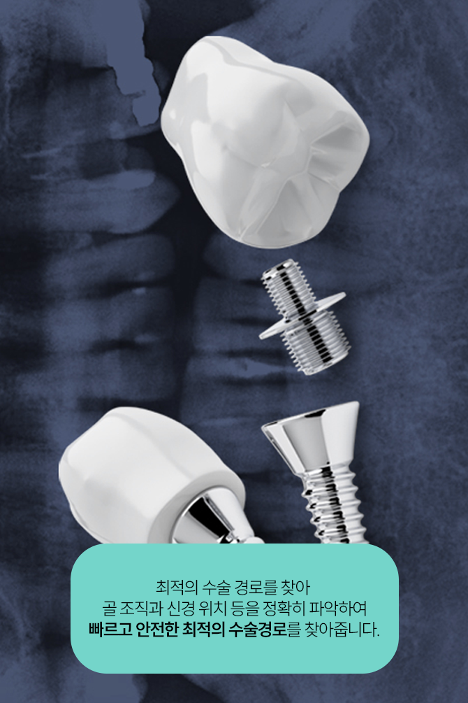 강남역 디지털임플란트 맞춤화된 진료 관련 이미지 7