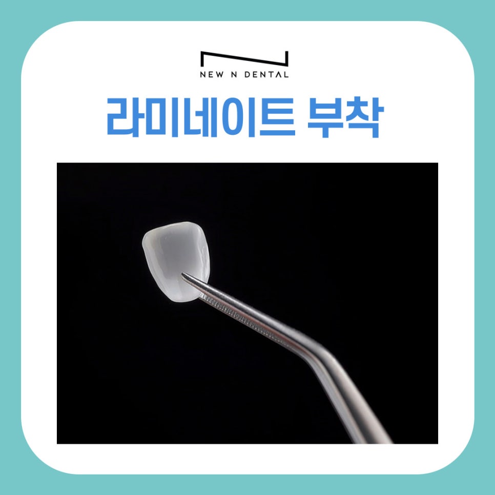 강남역치과 라미네이트 방법, 단계별로 알아보기 관련 이미지 8