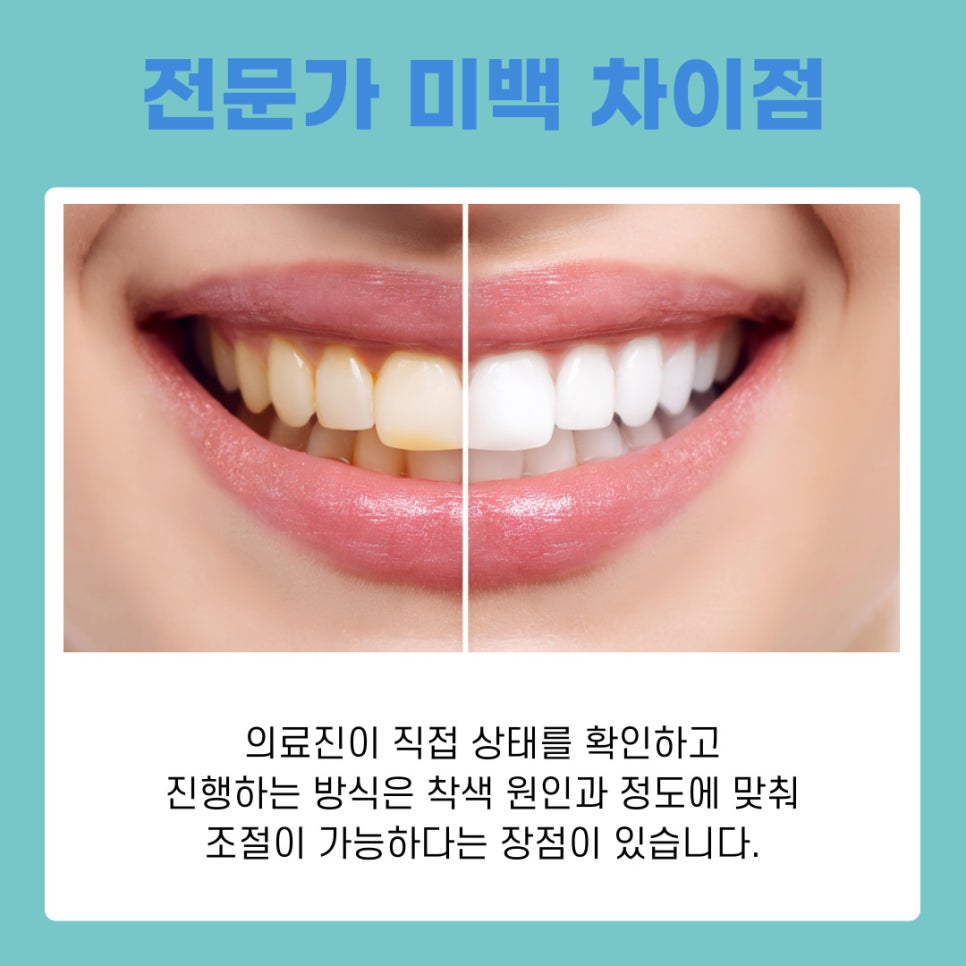 논현역 치과 원데이 치아미백 중요한 날 앞두고 많이 찾는 이유 관련 이미지 5