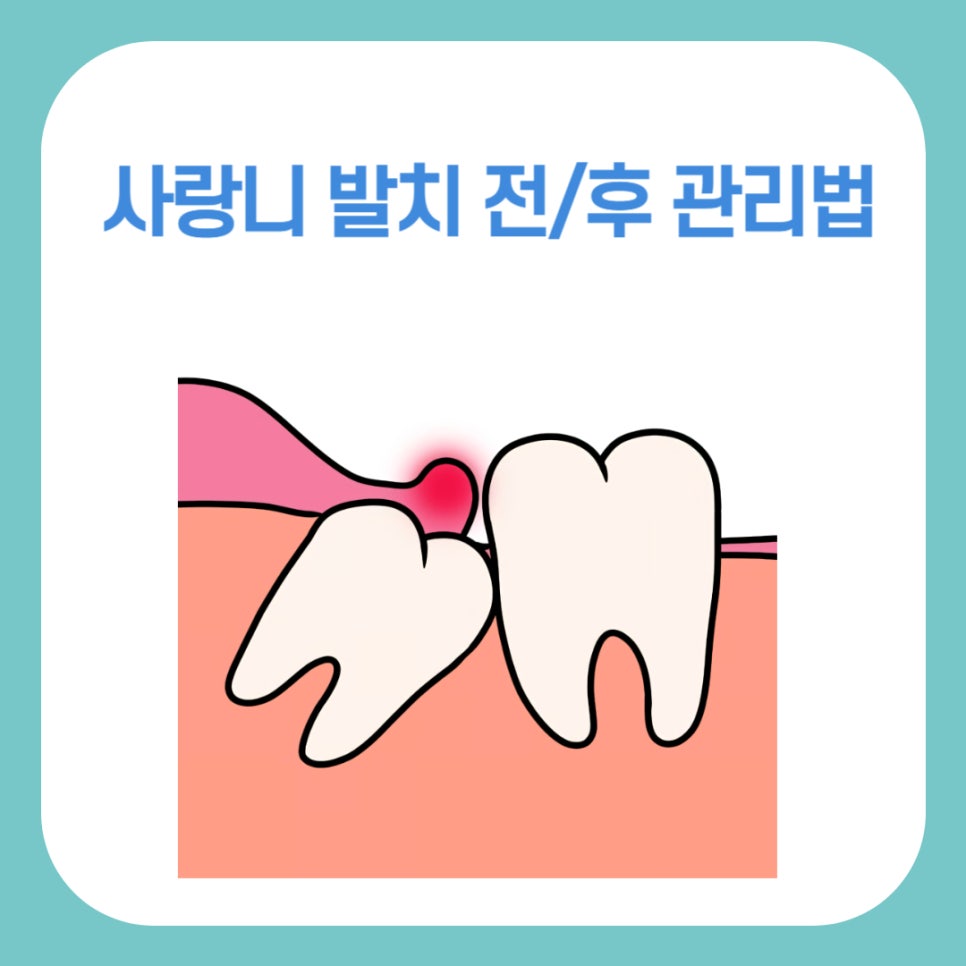 사랑니 발치 전 후 관리법 꿀팁 관련 이미지 1