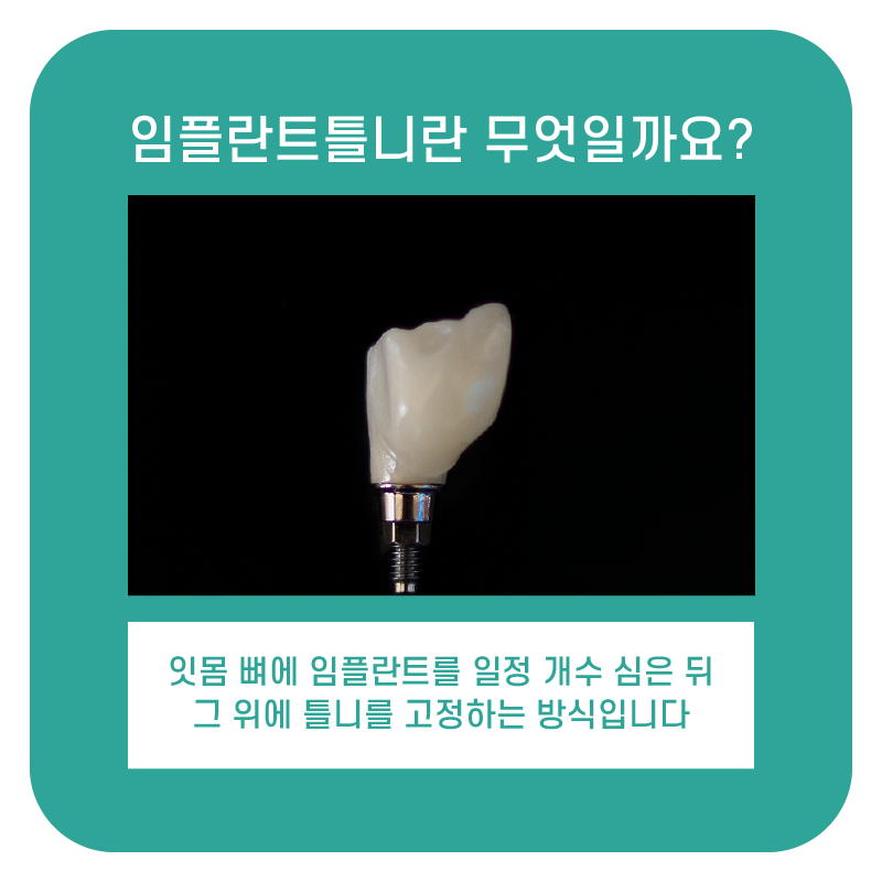 강남임플란트틀니 치아 기능과 심미성 회복하는 방법 관련 이미지 3