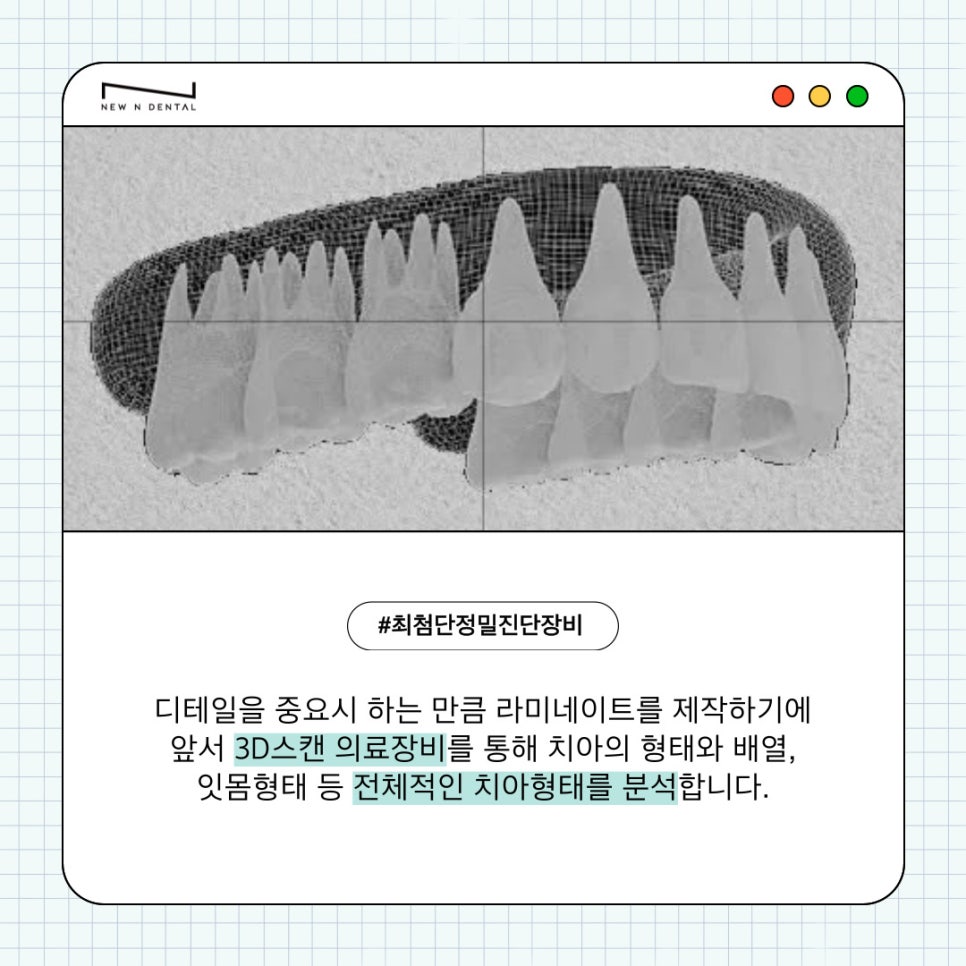 자연치아를 최대한 보호하는 최소삭제라미네이트 관련 이미지 8