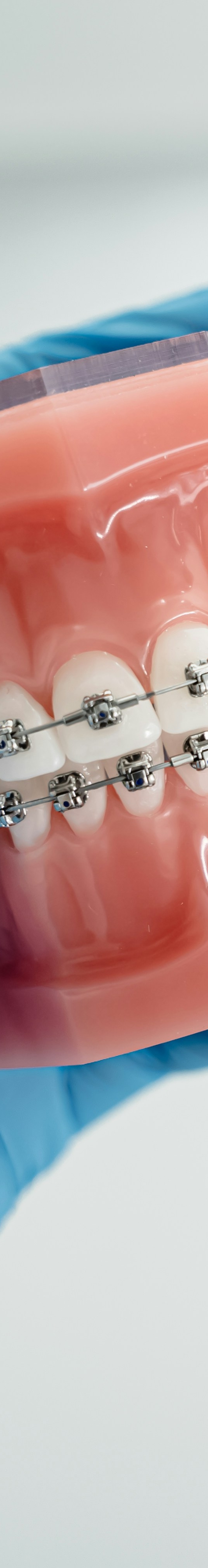 치아교정 후 유지 장치의 필요성 관련 이미지 11