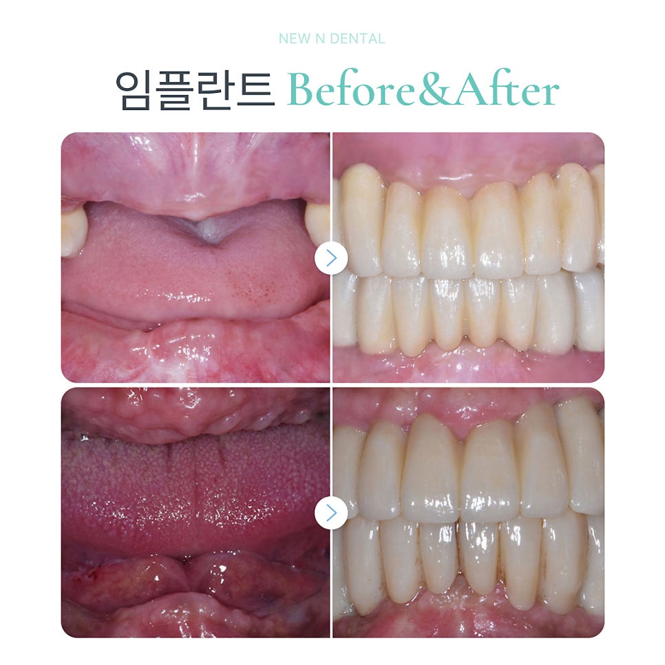 임플란트수술비용과 치료 과정에 대한 정보 관련 이미지 10