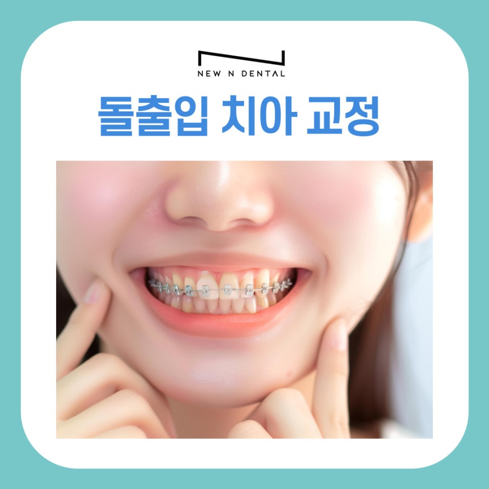 논현역치과 돌출입 치아 교정 비발치로 가능 할까? 관련 이미지 2