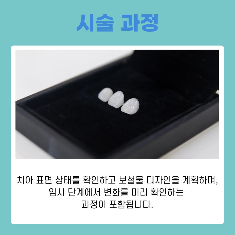 신사동 라미네이트 치과 무삭제 치아성형 자연스러운 변화 관련 이미지 5