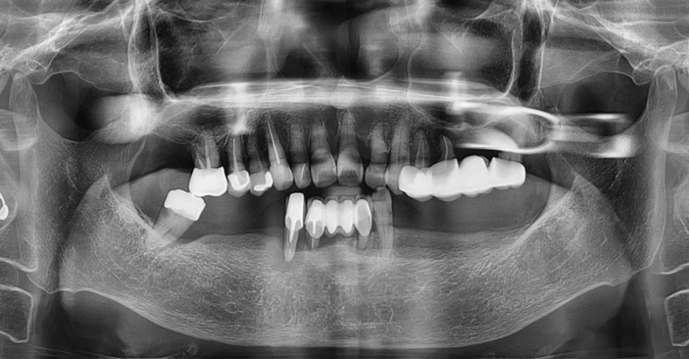 강남임플란트잘하는치과 찾는다면 관련 이미지 8